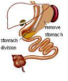 Uniform Sleeve – Gastrectomy